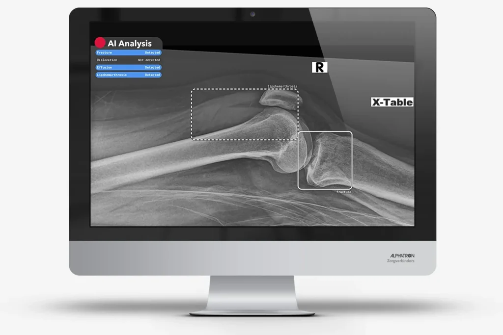 aifi-pilot-gestart-nieuwsbericht-alphatron-zorgverbinders-artificial-intelligence-for-imaging